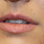 Lip Filler Before & After Patient #29765