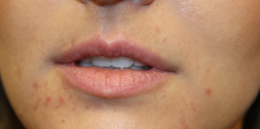 Lip Filler Before & After Patient #29765