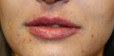 Lip Filler Before & After Patient #29765