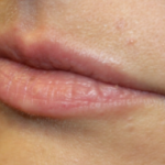 Lip Filler Before & After Patient #29765