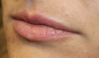 Lip Filler Before & After Patient #29765