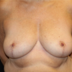 Breast Reduction Before & After Patient #29741