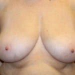 Breast Reduction Before & After Patient #29741