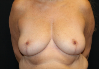 Breast Reduction Before & After Patient #29741