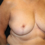 Breast Reduction Before & After Patient #29741