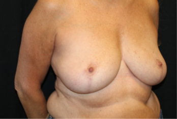 Breast Reduction Before & After Patient #29741