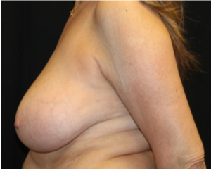 Breast Reduction Before & After Patient #29741