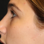 Rhinoplasty Before & After Patient #29754