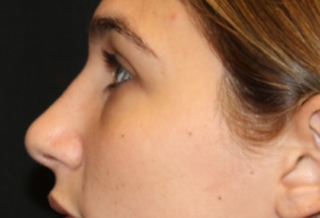 Rhinoplasty Before & After Patient #29754