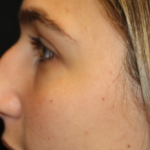 Rhinoplasty Before & After Patient #29754