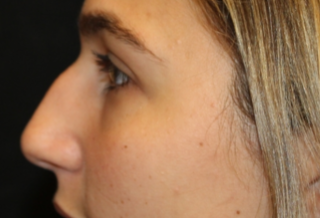 Rhinoplasty Before & After Patient #29754