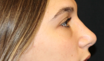 Rhinoplasty Before & After Patient #29754