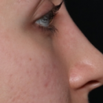 Rhinoplasty Before & After Patient #29665