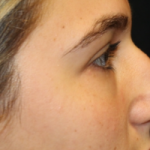 Rhinoplasty Before & After Patient #29754