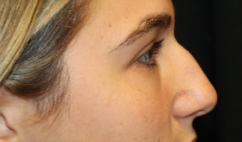 Rhinoplasty Before & After Patient #29754