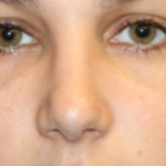 Rhinoplasty Before & After Patient #29754