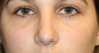 Rhinoplasty Before & After Patient #29754