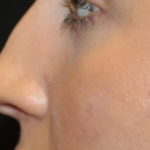 Rhinoplasty Before & After Patient #29665