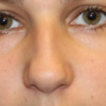 Rhinoplasty Before & After Patient #29754