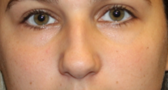 Rhinoplasty Before & After Patient #29754