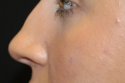 Rhinoplasty Before & After Patient #29665