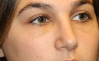 Rhinoplasty Before & After Patient #29754