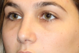 Rhinoplasty Before & After Patient #29754