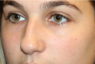 Rhinoplasty Before & After Patient #29754