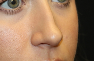 Rhinoplasty Before & After Patient #29665