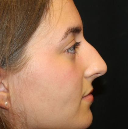 Rhinoplasty Before & After Patient #29674