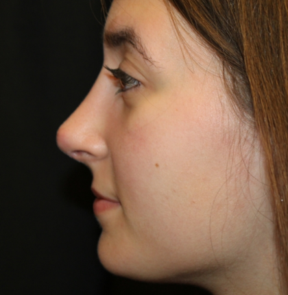 Rhinoplasty Before & After Patient #29674