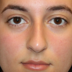 Rhinoplasty Before & After Patient #29674