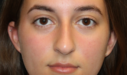 Rhinoplasty Before & After Patient #29674