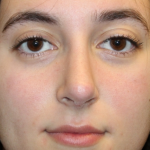Rhinoplasty Before & After Patient #29674