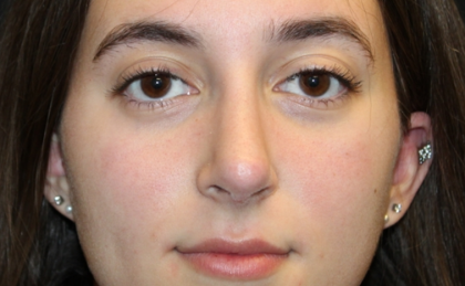 Rhinoplasty Before & After Patient #29674