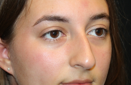 Rhinoplasty Before & After Patient #29674