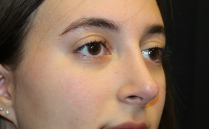 Rhinoplasty Before & After Patient #29674