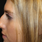 Rhinoplasty Before & After Patient #29683