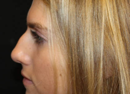 Rhinoplasty Before & After Patient #29683