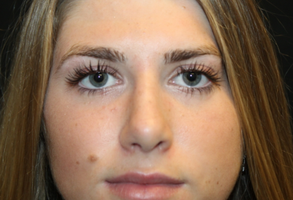 Rhinoplasty Before & After Patient #29683