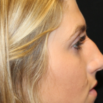Rhinoplasty Before & After Patient #29683