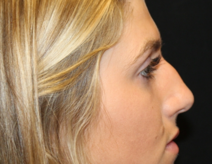 Rhinoplasty Before & After Patient #29683