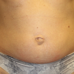 Tummy Tuck Before & After Patient #29642