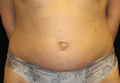 Tummy Tuck Before & After Patient #29642