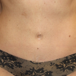 Tummy Tuck Before & After Patient #29642