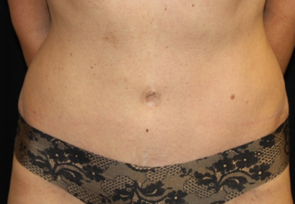 Tummy Tuck Before & After Patient #29642