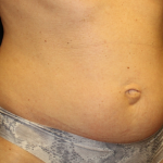 Tummy Tuck Before & After Patient #29642