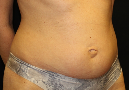 Tummy Tuck Before & After Patient #29642