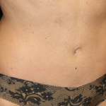 Tummy Tuck Before & After Patient #29642