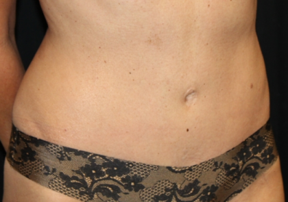 Tummy Tuck Before & After Patient #29642